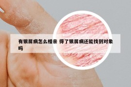 有銀屑病怎么相親 得了銀屑病還能找到對象嗎