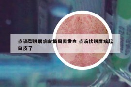 點(diǎn)滴型銀屑病皮損周圍發(fā)白 點(diǎn)滴狀銀屑病起白皮了