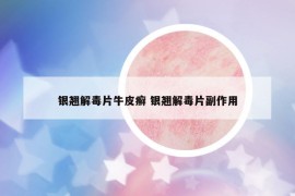 銀翹解毒片牛皮癬 銀翹解毒片副作用