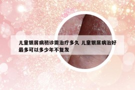 兒童銀屑病初診需治療多久 兒童銀屑病治好最多可以多少年不復(fù)發(fā)