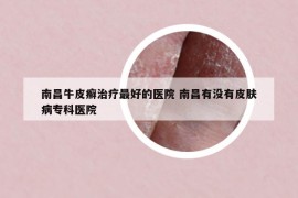南昌牛皮癬治療最好的醫(yī)院 南昌有沒有皮膚病專科醫(yī)院