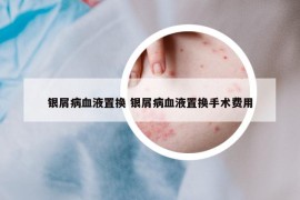 銀屑病血液置換 銀屑病血液置換手術(shù)費(fèi)用