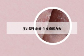壓力型牛皮癬 牛皮癬壓力大