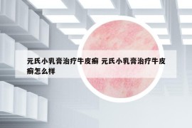 元氏小乳膏治療牛皮癬 元氏小乳膏治療牛皮癬怎么樣
