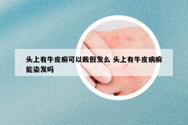 頭上有牛皮癬可以戴假發(fā)么 頭上有牛皮病癬能染發(fā)嗎