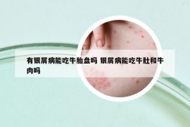 有銀屑病能吃牛胎盤嗎 銀屑病能吃牛肚和牛肉嗎