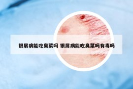 銀屑病能吃臭菜嗎 銀屑病能吃臭菜嗎有毒嗎