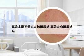 耳朵上是不是也會長銀屑病 耳朵會有銀屑病嗎