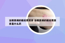 治銀屑病的糖皮質激素 治銀屑病的糖皮質激素是什么藥