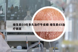 維生素D3吃多久治療牛皮癬 維生素d3治療銀屑