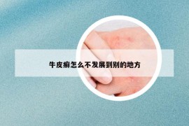 牛皮癬怎么不發(fā)展到別的地方