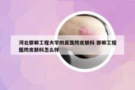 河北邯鄲工程大學(xué)附屬醫(yī)院皮膚科 邯鄲工程醫(yī)院皮膚科怎么樣