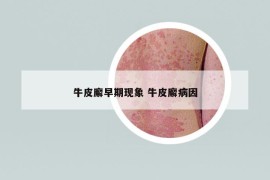 牛皮廨早期現(xiàn)象 牛皮廨病因