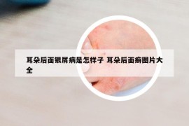 耳朵后面銀屑病是怎樣子 耳朵后面癬圖片大全