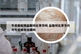 牛皮癬能擦鹽酸特比萘芬嗎 鹽酸特比萘芬片對牛皮癬有效果嗎