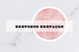 銀屑病甲狀腺切除 銀屑病甲治愈貼吧
