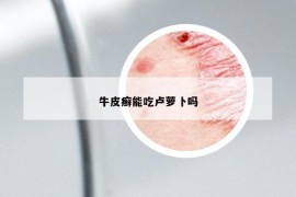 牛皮癬能吃盧蘿卜嗎