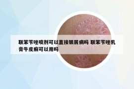 聯(lián)苯芐唑噴劑可以直接銀屑病嗎 聯(lián)苯芐唑乳膏牛皮癬可以用嗎
