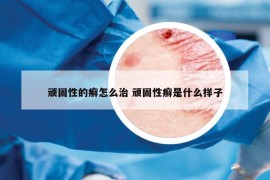 頑固性的癬怎么治 頑固性癬是什么樣子