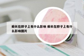癬長在脖子上有什么影響 癬長在脖子上有什么影響圖片