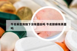 牛皮癬顯微鏡下沒(méi)有菌絲嗎 牛皮膚癬有真菌嗎