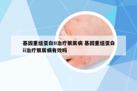 基因重組蛋白II治療銀屑病 基因重組蛋白ii治療銀屑病有效嗎