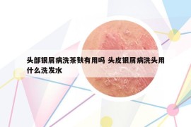 頭部銀屑病洗茶麩有用嗎 頭皮銀屑病洗頭用什么洗發(fā)水