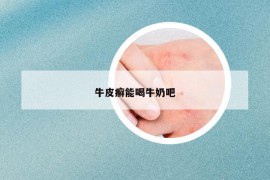 牛皮癬能喝牛奶吧