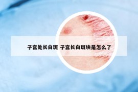 子宮處長白斑 子宮長白斑塊是怎么了