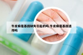 牛皮癬是基因缺失引起的嗎 牛皮癬是基因遺傳嗎