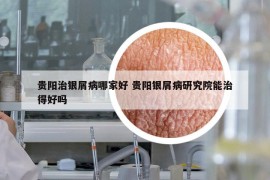 貴陽治銀屑病哪家好 貴陽銀屑病研究院能治得好嗎