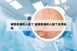 被銀屑病的人碰了 被銀屑病的人碰了會(huì)傳染嗎