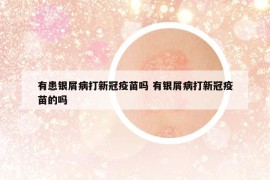 有患銀屑病打新冠疫苗嗎 有銀屑病打新冠疫苗的嗎