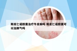 斯皮仁諾膠囊治療牛皮癬嗎 斯皮仁諾膠囊可以治腳氣嗎