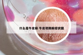什么是牛皮癬 牛皮初期癬癥狀圖
