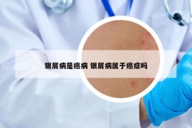 銀屑病是癌病 銀屑病屬于癌癥嗎
