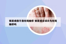 銀屑病像不像玫瑰糠疹 銀屑病會誤診為玫瑰糠疹嗎