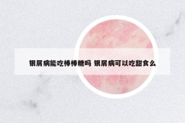 銀屑病能吃棒棒糖嗎 銀屑病可以吃甜食么