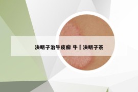 決明子治牛皮癬 牛篣決明子茶