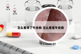 怎么看得了牛皮癬 怎么看是牛皮癬