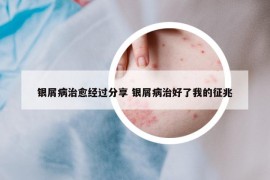 銀屑病治愈經(jīng)過(guò)分享 銀屑病治好了我的征兆