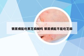 銀屑病能吃黑芝麻糊嗎 銀屑病能不能吃芝麻