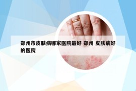 鄭州市皮膚病哪家醫(yī)院最好 鄭州 皮膚病好的醫(yī)院