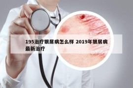 195治療銀屑病怎么樣 2019年銀屑病最新治療