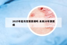 2025年能攻克銀屑病嗎 未來20年銀屑病