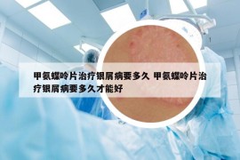 甲氨蝶呤片治療銀屑病要多久 甲氨蝶呤片治療銀屑病要多久才能好