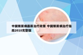 中國(guó)銀屑病最新治療政策 中國(guó)銀屑病治療指南2018完整版