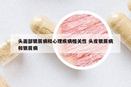 頭面部銀屑病和心理疾病相關(guān)性 頭皮銀屑病和銀屑病
