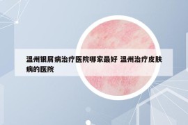 溫州銀屑病治療醫(yī)院哪家最好 溫州治療皮膚病的醫(yī)院