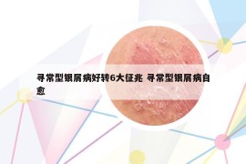 尋常型銀屑病好轉(zhuǎn)6大征兆 尋常型銀屑病自愈